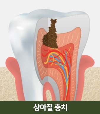 The Power to Protect Natural Teeth: Seoul Orbe Dental Hospital’s Philosophy of Conservative Treatment image 4