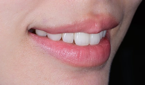Canine Veneers Without Orthodontic Treatment image 7