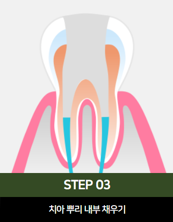 The Power to Protect Natural Teeth: Seoul Orbe Dental Hospital’s Philosophy of Conservative Treatment image 13