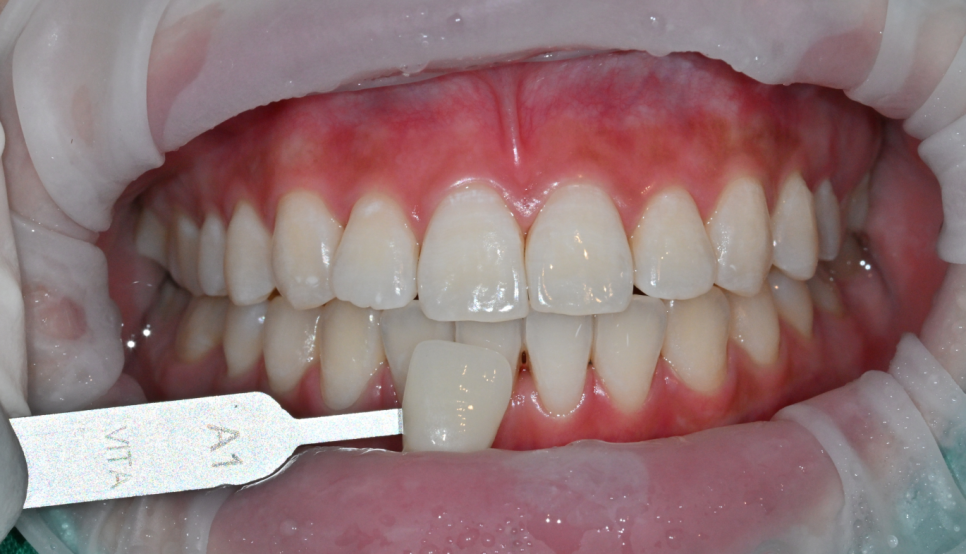 Jamsil Teeth Whitening: Can You See Results in Just One Day? image 6