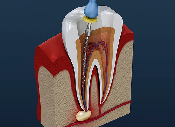 When Exactly Should Root Canal Treatment Be Done? image 1