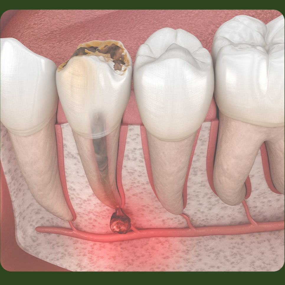 치아 염증, 뿌리끝에 생겼다면? 관련 이미지 2