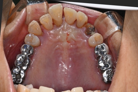 앞니 임플란트, 전치부 심미까지 살린 치료 과정 정리 관련 이미지 7