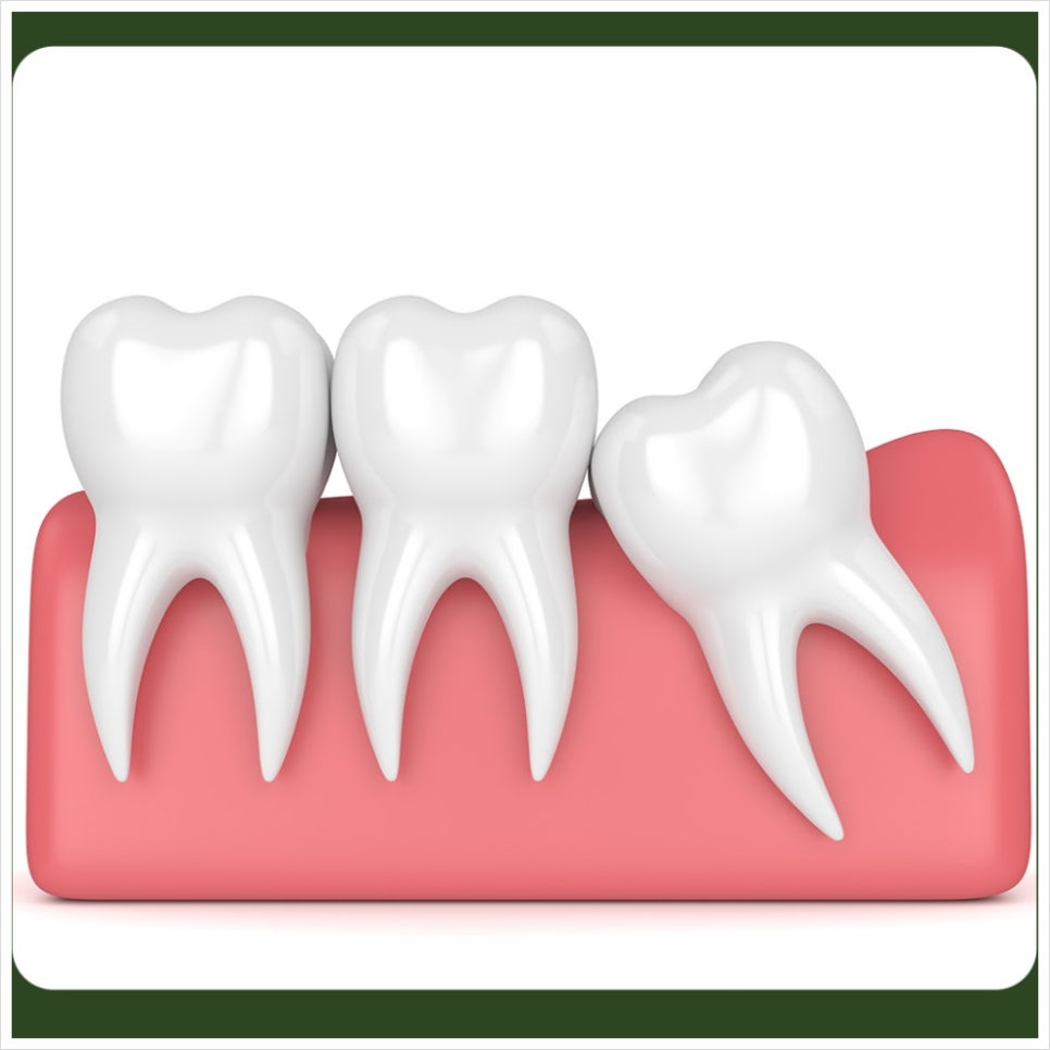 Bad Breath After Wisdom Tooth Extraction: What If It Got Worse After the Extraction? image 3