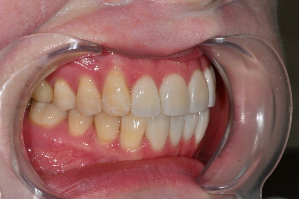 Songpa Dental Clinic: A Case of Improving Mottled Teeth with Veneers image 8