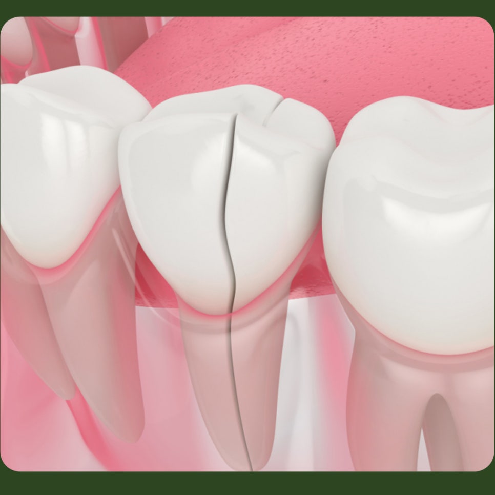 What Causes Tooth Cracks? Why Do They Form? image 4