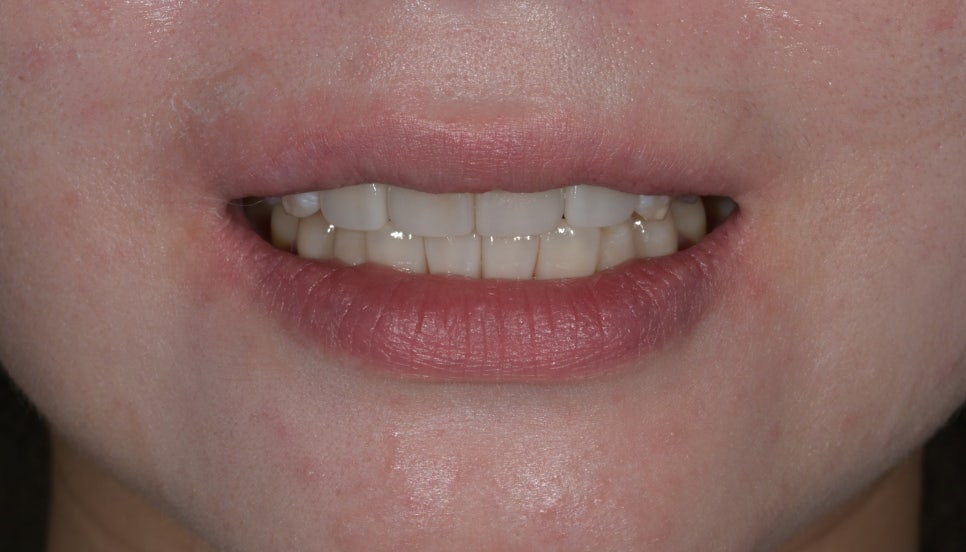 Songpa Dental Clinic: A Case of Improving Mottled Teeth with Veneers image 6