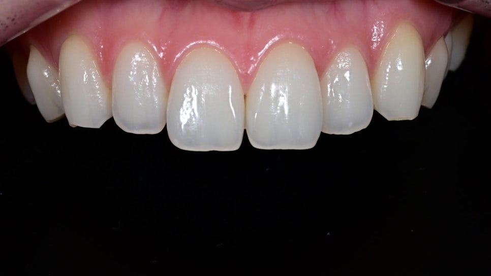 Canine Veneers Without Orthodontic Treatment image 1