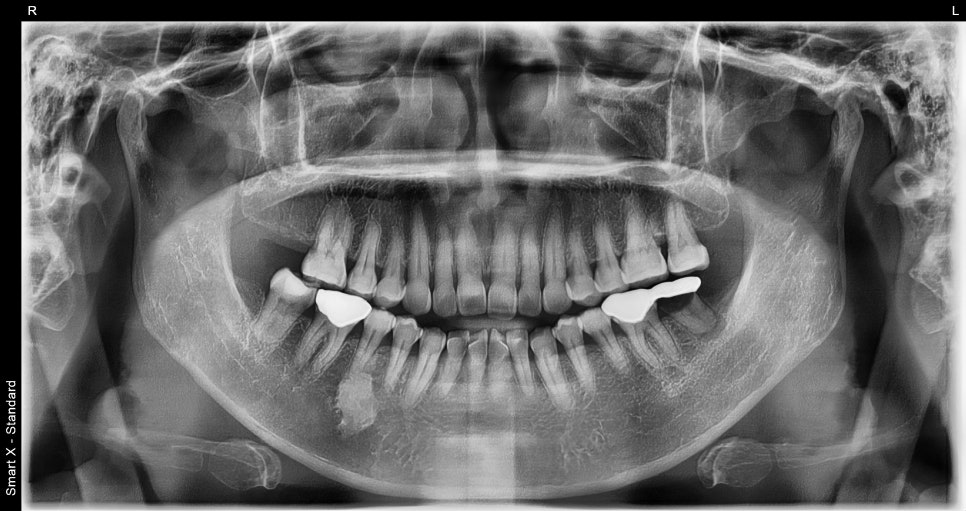 Sammyeon Station Dental Clinic Molars Implant Price, Treatment Process from Extraction to Prosthetics image 2