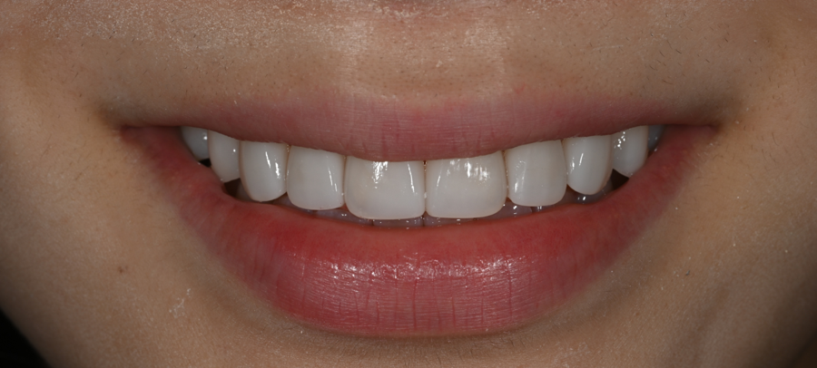 Jamsil no-prep laminate veneers: a real case of changing the impression without filing down the teeth image 17