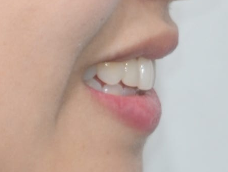 Laminate Veneers for Protruding Teeth: If They’re Too Thick, They Look Even More Prominent image 7