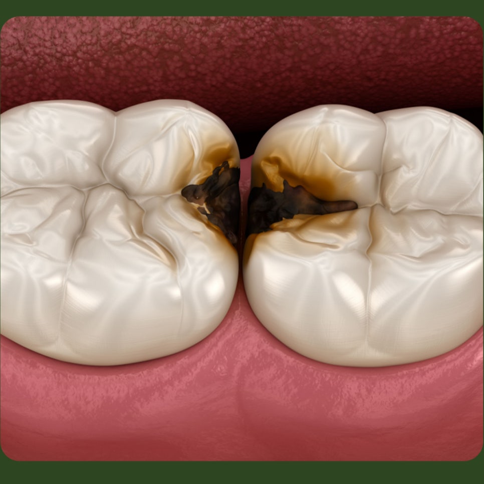 Cavities Between Teeth: What Causes Them and How Are They Treated? image 3