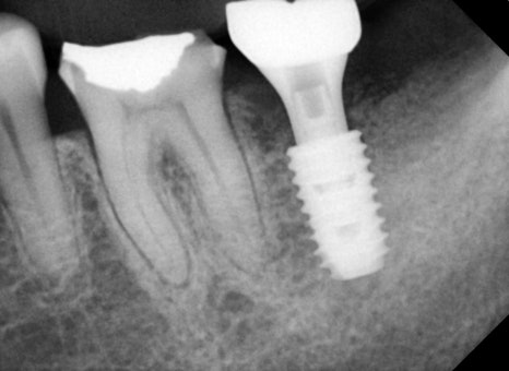 Sammyeon Station Dental Clinic Molars Implant Price, Treatment Process from Extraction to Prosthetics image 10