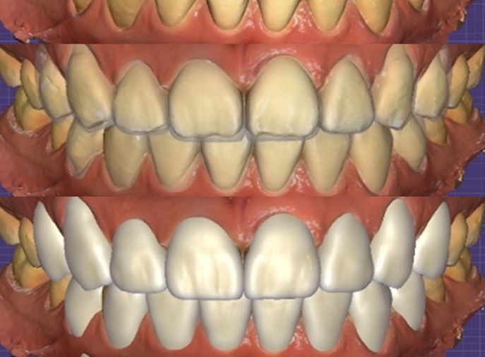 Front Tooth Laminate Veneers Are Natural Even at 70 — A Senior OVZERO Treatment Case image 7
