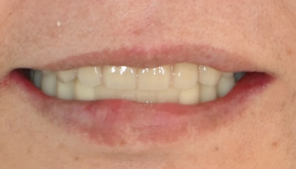 How Are Snap-On Dentures and Full-Mouth Implant Costs Handled at an Implant Dental Clinic? image 15