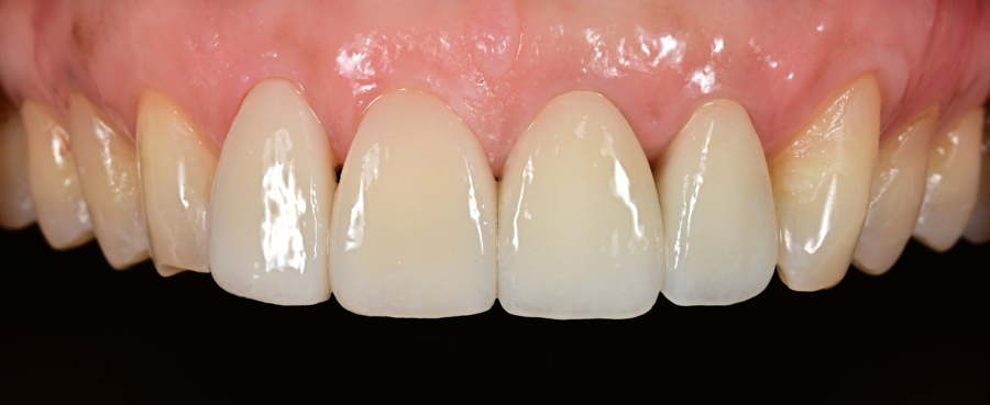 How Was Sensitivity and Discomfort Resolved After Implant Treatment in Jamsil? image 16