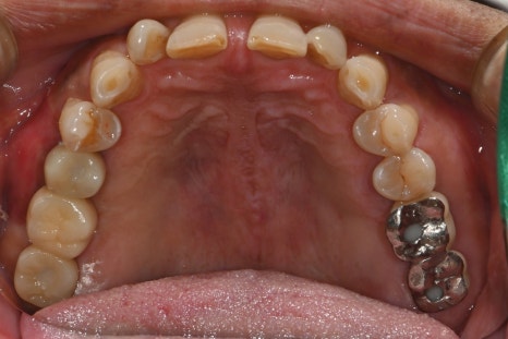 Don’t wait after extraction—place it right away! The golden time when bone comes back to life image 6