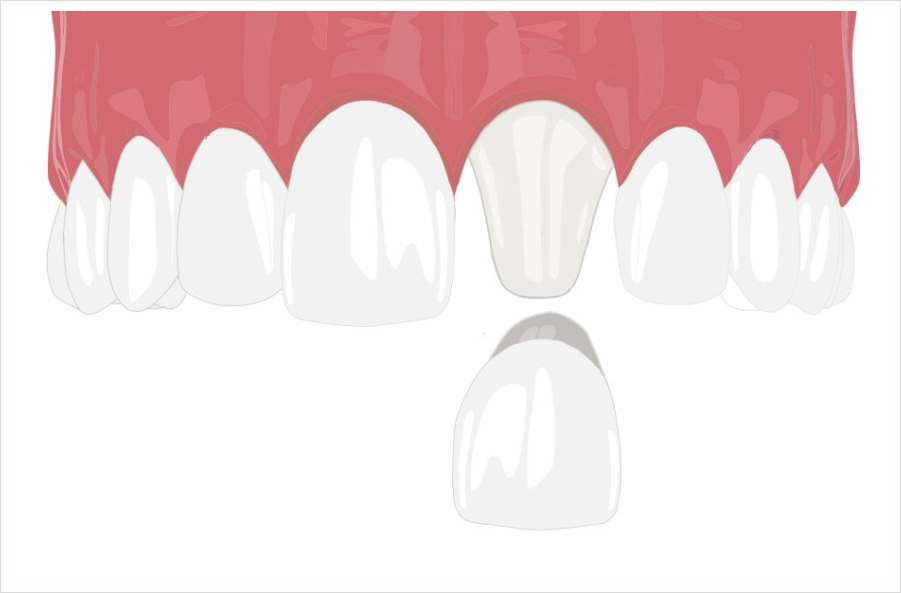 Concerned About Gaps Between Your Front Teeth? image 4