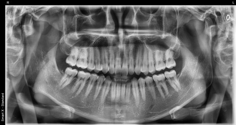 The Real Reason for the Price Difference in Laminates: See for Yourself with OVZERO Minimally Prepared Veneers image 4