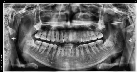 Why the Front Teeth Laminate Changed Naturally with Obzero Laminate image 2