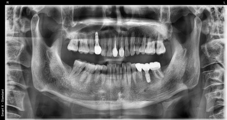 Are you afraid of the dentist? With sedation treatment, you can get root canal treatment and implant surgery without worry! image 3