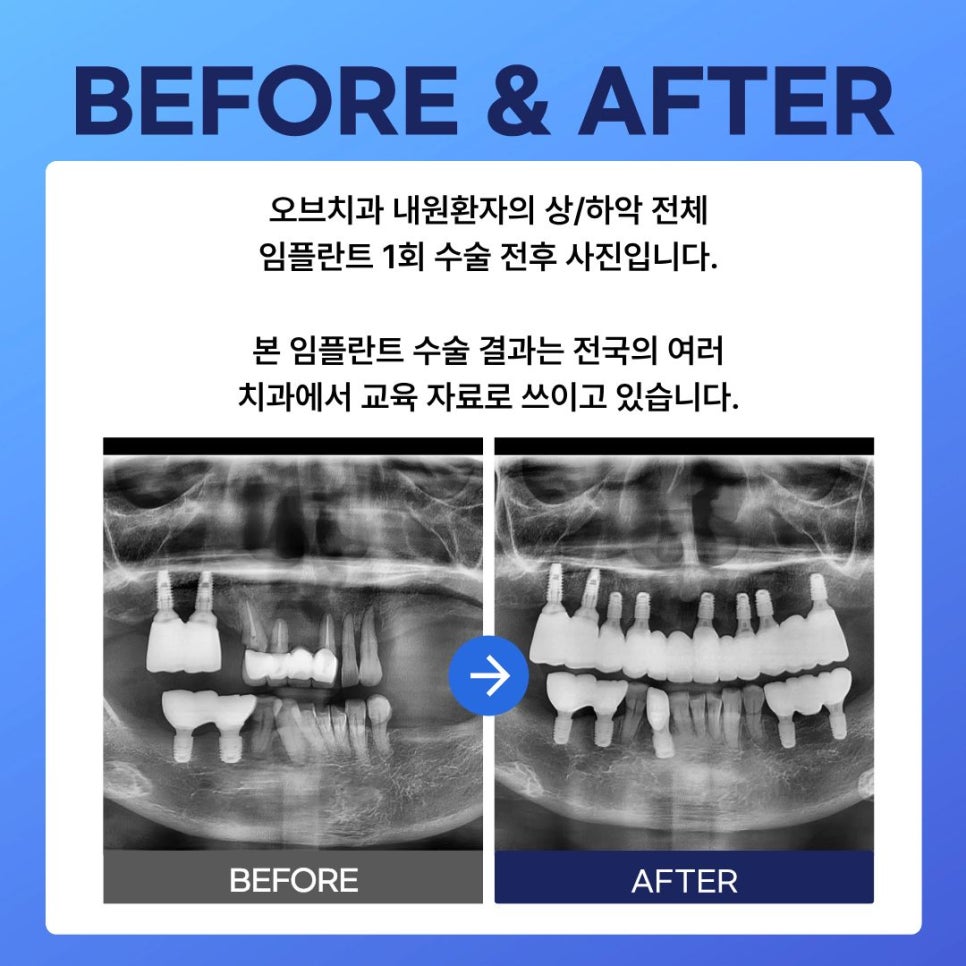 Full-Mouth Implant Price: Treatment Review of a Patient in Their 60s Who Restored Damaged Teeth image 1