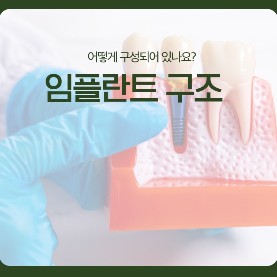 임플란트 구조, 어떻게 구성되어 있나요? 관련 이미지 1