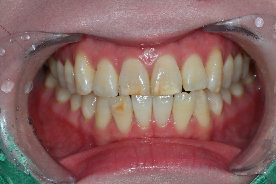 Songpa Dental Clinic: A Case of Improving Mottled Teeth with Veneers image 3