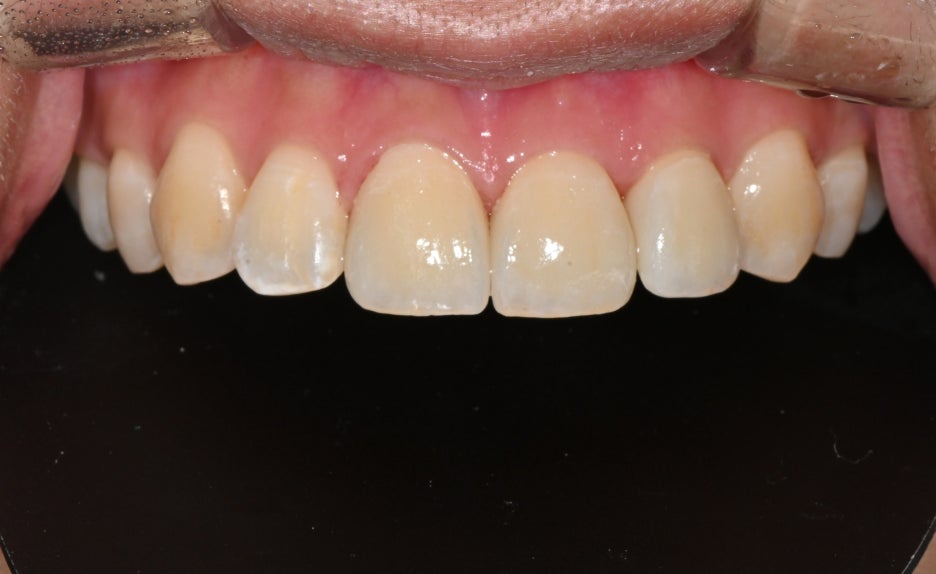 Songpa Dental Clinic, a Case of Crown Restoration After Root Canal Treatment for a Woman in Her 20s With a Broken Front Tooth image 12