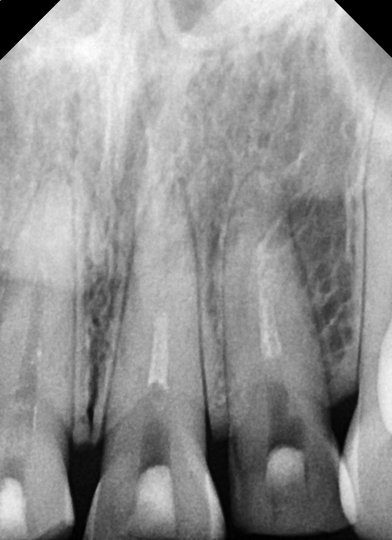 Songpa Dental Clinic, a Case of Crown Restoration After Root Canal Treatment for a Woman in Her 20s With a Broken Front Tooth image 9
