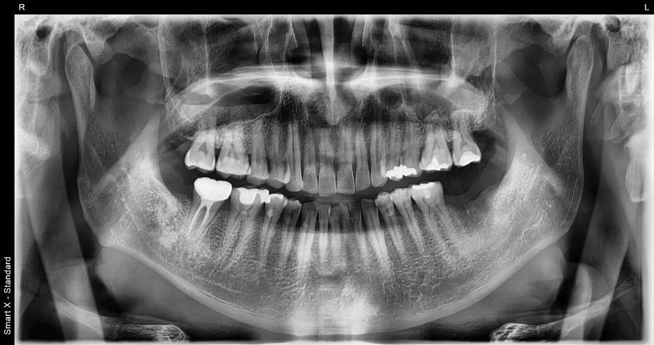 Jamsil Dental Hospital Implant Price and Treatment Case image 8