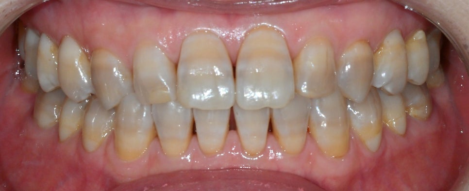 Objet Laminate Treatment for Seniors: Naturally Beautiful, Without Tooth Reduction image 10