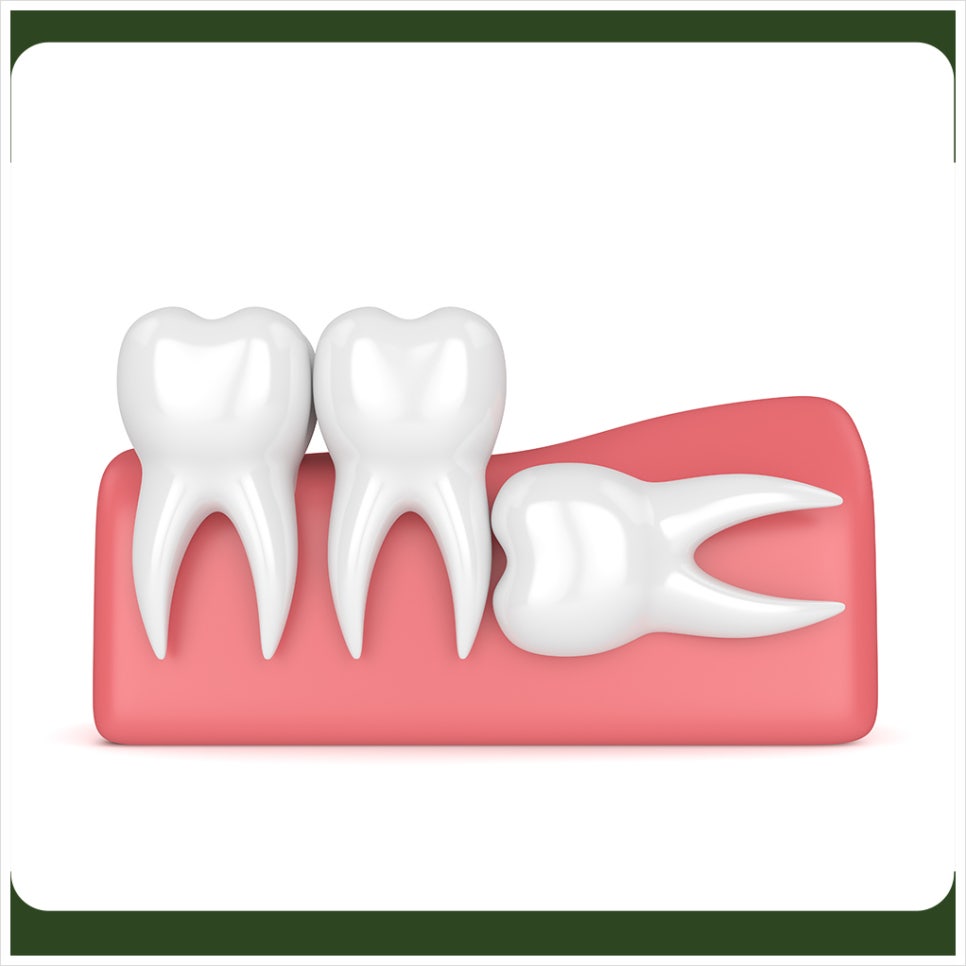 Should a horizontally impacted wisdom tooth be removed? image 4
