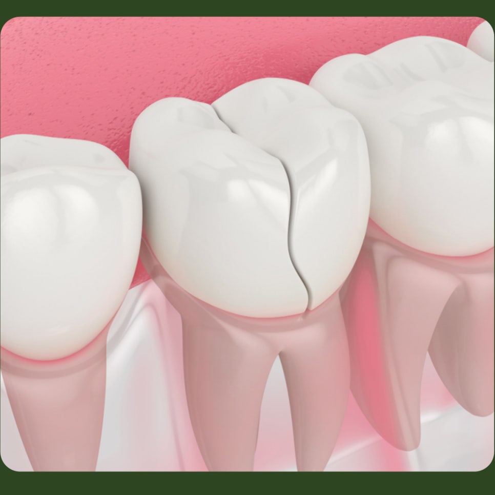 What Causes Tooth Cracks? Why Do They Form? image 3