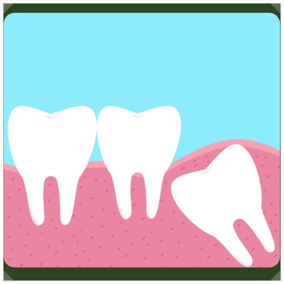 Pain After Wisdom Tooth Extraction: If It’s Getting Worse, Please Read This! image 2