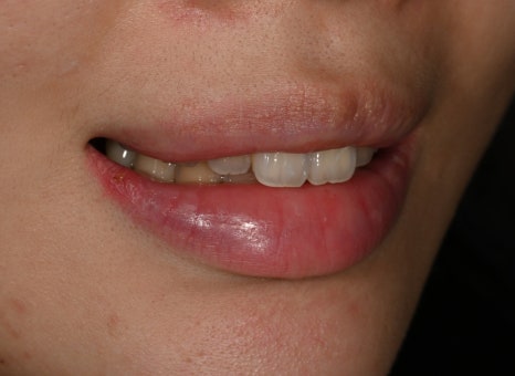Jamsil Veneers: Worried About Rabbit Teeth? image 3