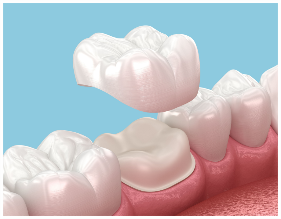 Why Is a Crown Placed After Root Canal Treatment? image 4