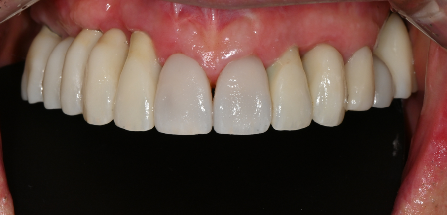 Front Tooth Laminate Veneers Are Natural Even at 70 — A Senior OVZERO Treatment Case image 8