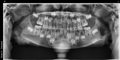 Pediatric Jaw Trauma: Can It Be Treated at a Dental Clinic Instead of a Plastic Surgery Clinic? See the Real Case image 1