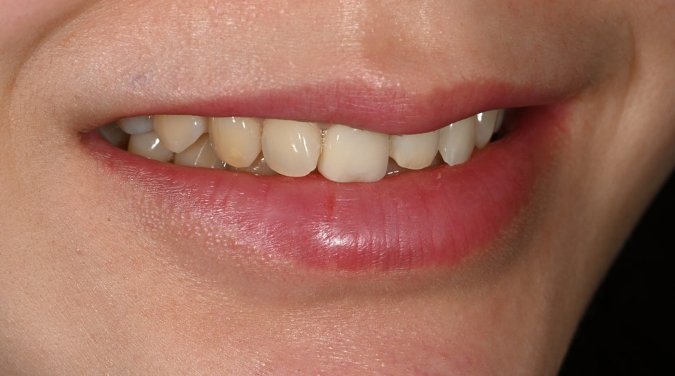 Tooth Wear: Resin? Veneers Are Also an Option image 3
