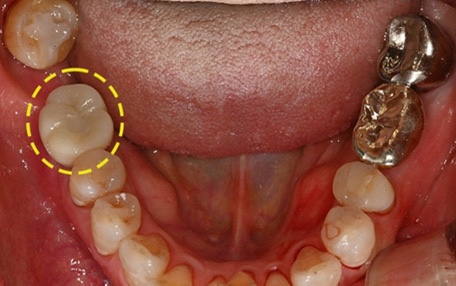 Why Is Sinus Lift Surgery Needed? image 4
