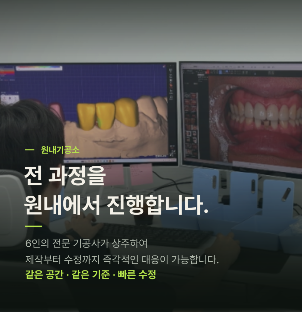 왜소치 라미네이트, 몇 개까지 해야 자연스러울까요? 관련 이미지 10