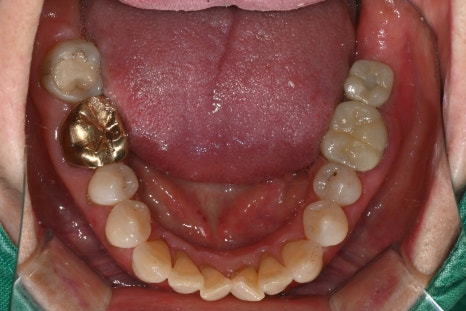 Sammyeon Station Dental Clinic Molars Implant Price, Treatment Process from Extraction to Prosthetics image 15