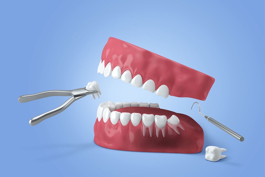 How to Care for Your Mouth After Wisdom Tooth Extraction image 2