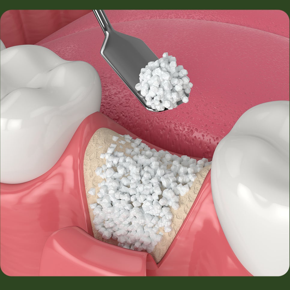 When Is Bone Grafting Needed for Implants? image 3