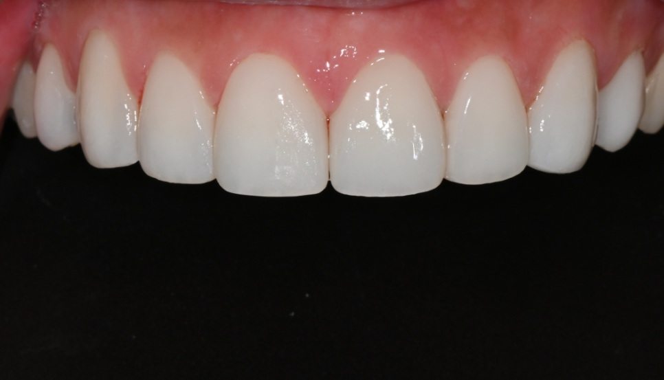 Natural-looking Front Teeth Completed with Laminate Veneers in Jamsil image 13