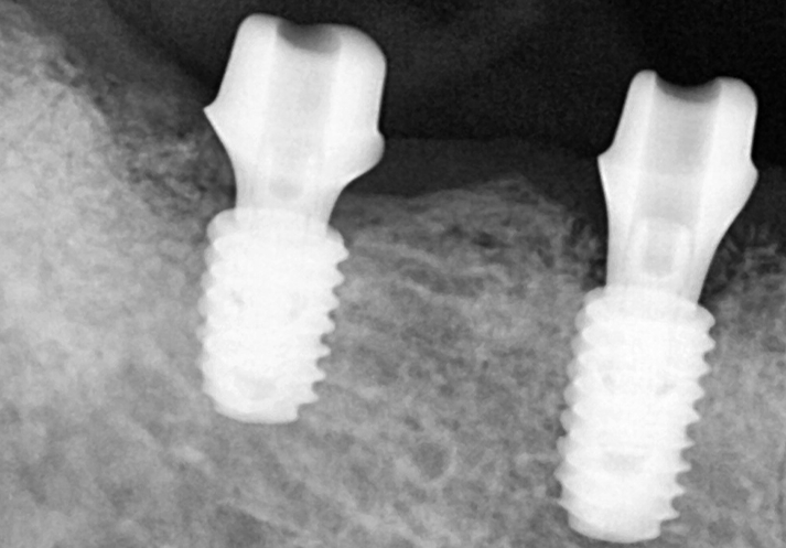 [Seokchon Gobun Station Dental Clinic] When Is an Implant Needed? image 6
