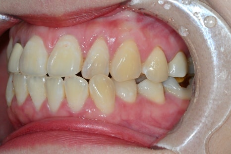 How We Naturally Improved an Upper Front Tooth Crown Retreatment, Including Color Differences and the Gum Line image 5
