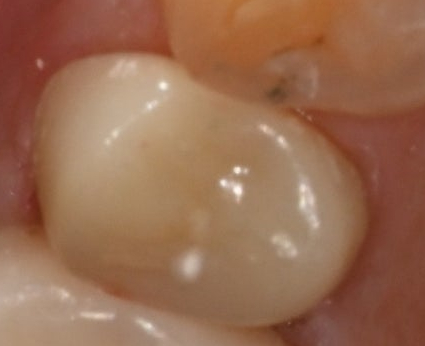 When a molar breaks, do you always need an implant? image 25