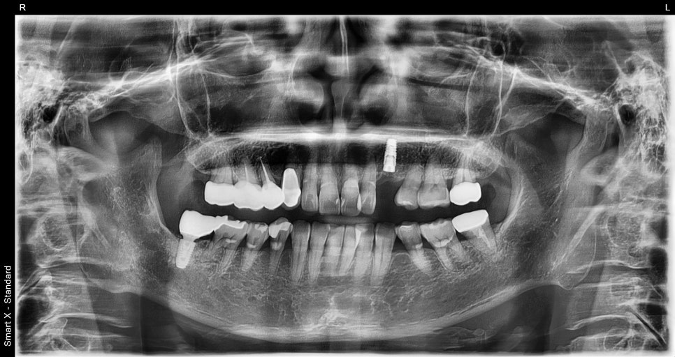 Songpa-gu Front Tooth Implant: Is It Possible Even in an Inflamed Area? image 7
